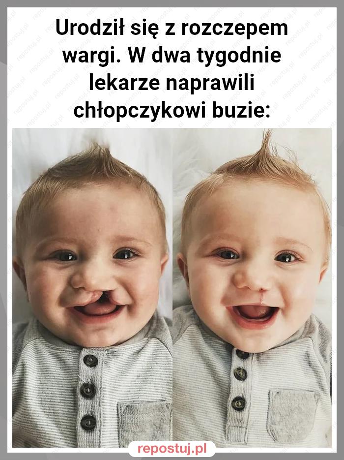 Urodził się z rozczepem wargi. W dwa tygodnie lekarze naprawili chłopczykowi buzie: